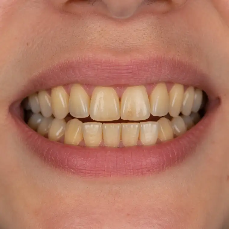 Smile before clear aligner treatment